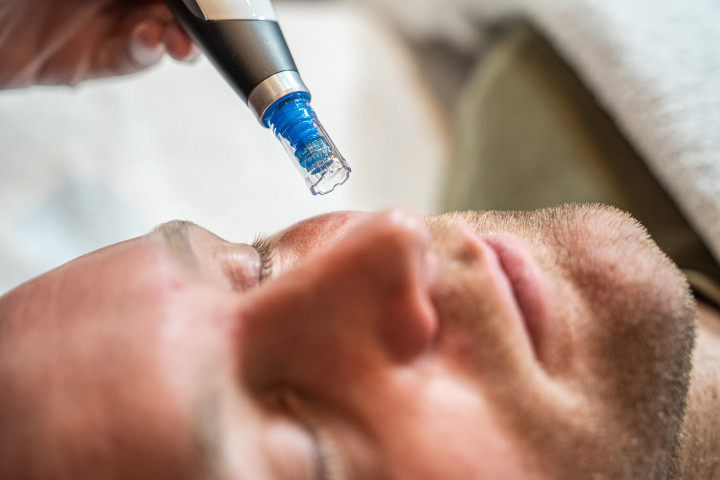 Microneedling